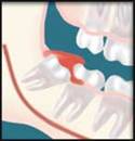 Infected Wisdom Tooth Extracted by Oral Surgeon in Decatur GA