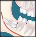 Wisdom Tooth Damaging adjacent teeth. Extracted by Oral Surgeon in Decatur GA
