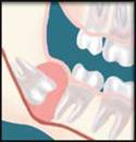 Infected Wisdom Tooth Extracted by Oral Surgeon in Decatur GA